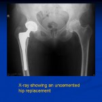 Uncemented Hip Replacement