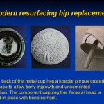 Resurfaceing hip replacement