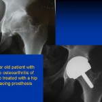 Severe osteoarthritis