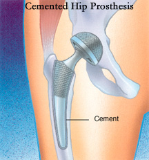 Cemented Hip Prosthesis