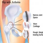 Hip with Arthritis