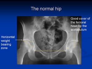 Normal Hip