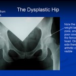Hip Dysplasia2