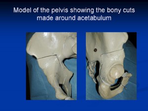 Hip-Dysplasia