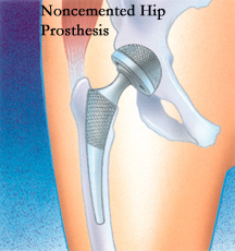Noncemented Hip Prosthesis