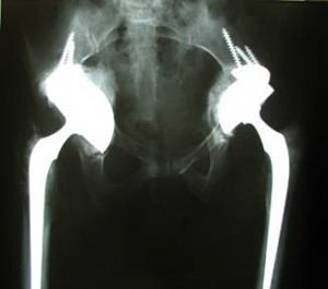 Hips reconstructed with specially designed acetabular components 