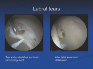 Labral Tears